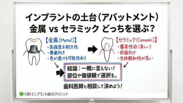 土台（アバットメント）は金属とセラミックのどちらが良い？違いと選び方をわかりやすく解説