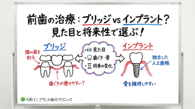 ブリッジとインプラント、前歯ではどちらを選ぶべき？見た目と将来性から考える治療の選び方