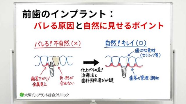 前歯のインプラントはバレない？不自然に見える原因と自然に仕上げるためのポイント