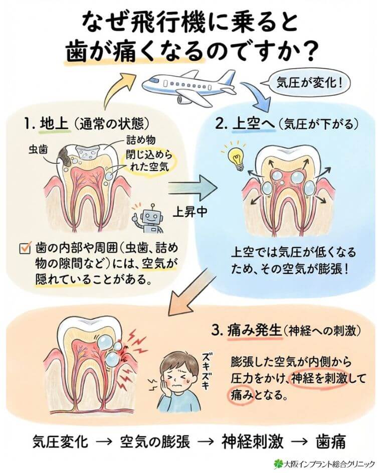 なぜ飛行機に乗ると歯が痛くなるのですか？