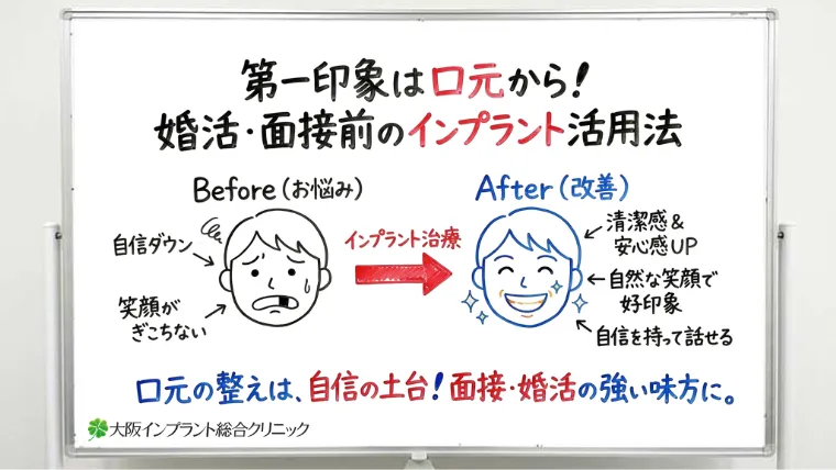 婚活・面接前に歯を治したいとき、インプラントは向いていますか