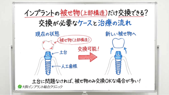 インプラントの被せ物（上部構造）だけ交換できる？交換が必要なケースと治療の流れ