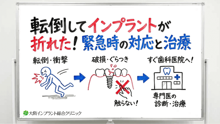 転倒してインプラントが折れた！緊急時の対応と歯科医院での治療を解説