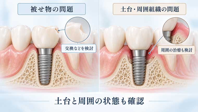 被せ物だけの交換で済むのか