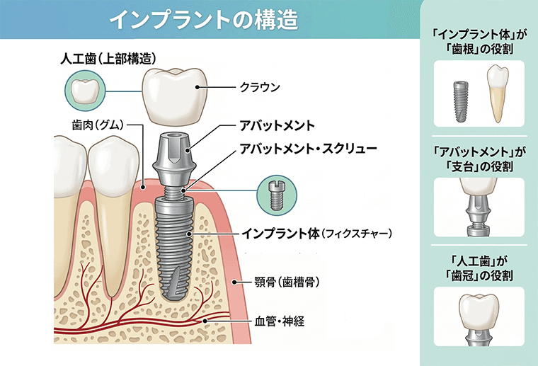 インプラントの構造