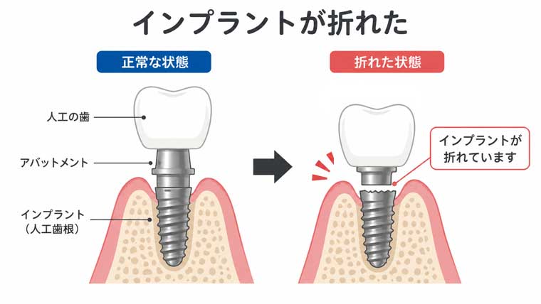 転倒してインプラントが折れた！緊急時の対応と歯科医院での治療を解説