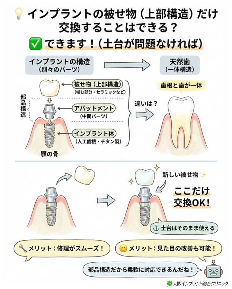 インプラントの被せ物（上部構造）だけ交換することはできる？