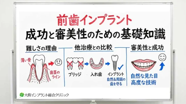 前歯のインプラント治療を検討する前に知っておきたい基礎知識