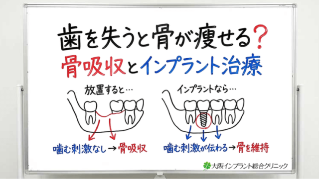歯を失うと骨が痩せるって本当？骨が痩せる理由とインプラント治療