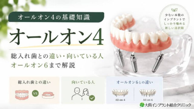 オールオン4の基礎知識｜総入れ歯との違い・向いている人・オールオン6