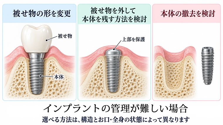 インプラントの管理が難しい場合