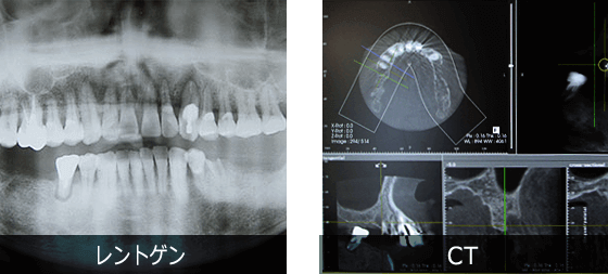 レントゲンと歯科用CTの違い