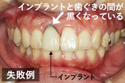 前歯のインプラント】治療前に知っておくべき5つのこと｜大阪の専門医院