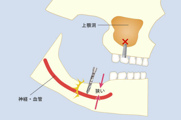 インプラントのリスクと安全性｜大阪の専門歯科医院