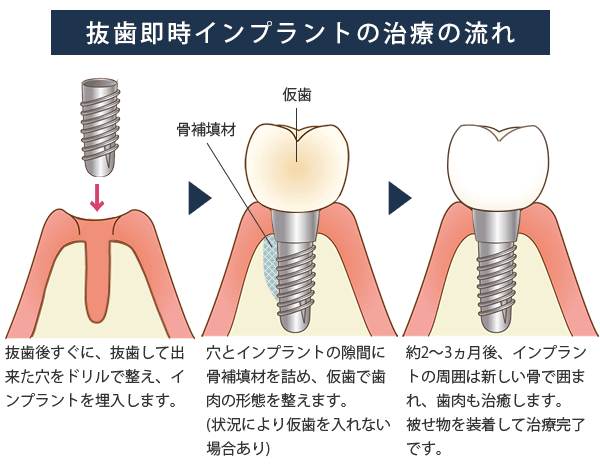 抜歯即時インプラントの治療の流れ