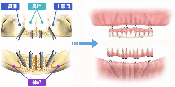 オールオン4 総入れ歯の方へ 全部の歯をインプラントに 大阪インプラント総合クリニック