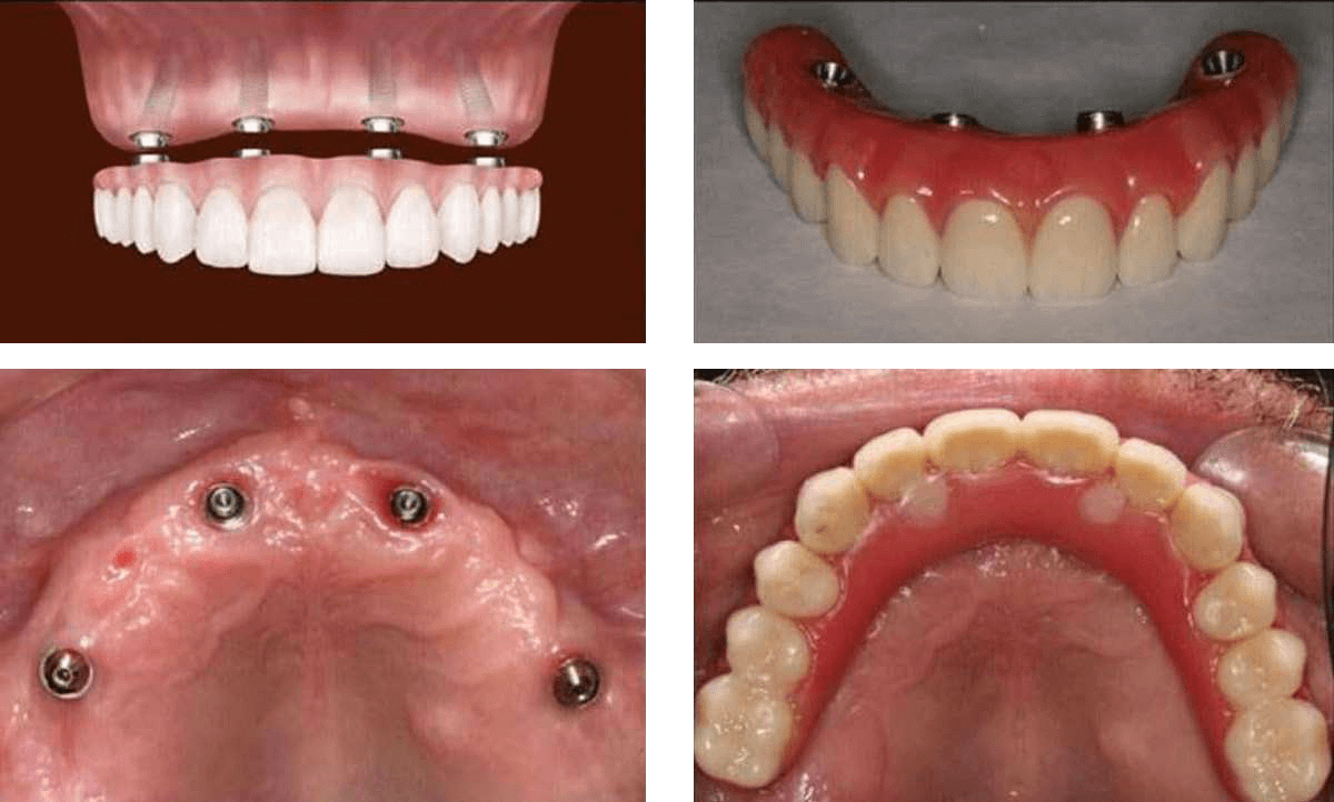 オールオン4 総入れ歯の方へ 全部の歯をインプラントに 大阪インプラント総合クリニック