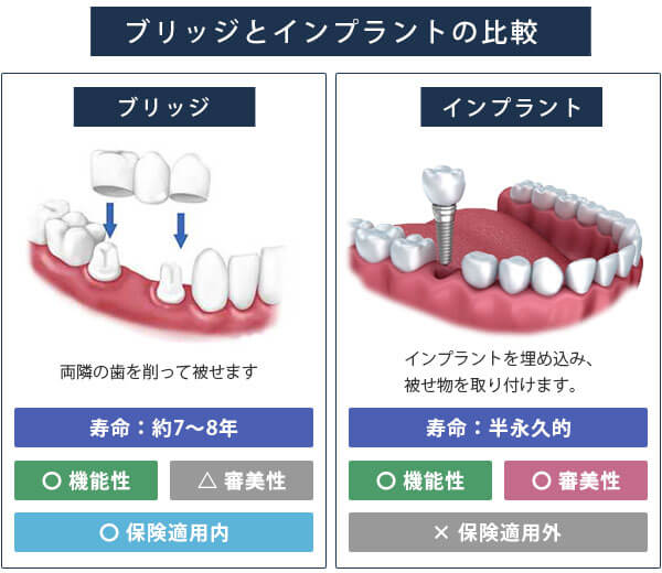 入れ歯 と インプラント どっち が いい