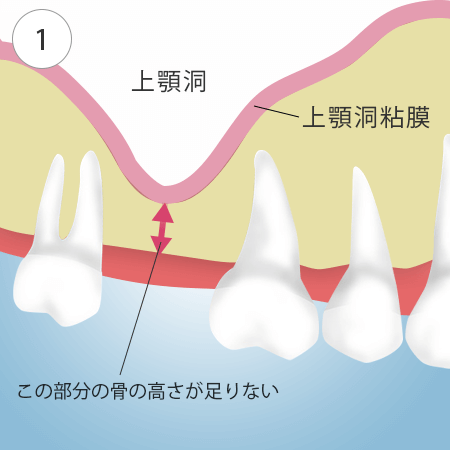 \Pbgtg̎菇1