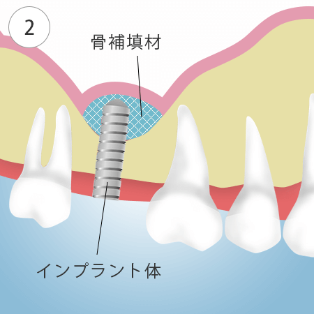 \Pbgtg̎菇2