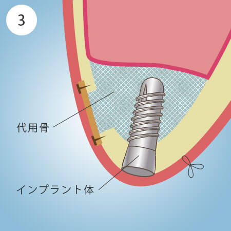 TCiXtgtg̎菇3