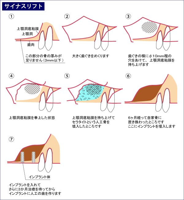 サイナスリフト