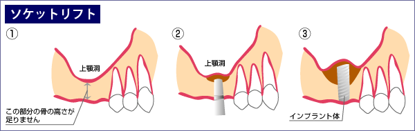 ソケットリフトの説明図