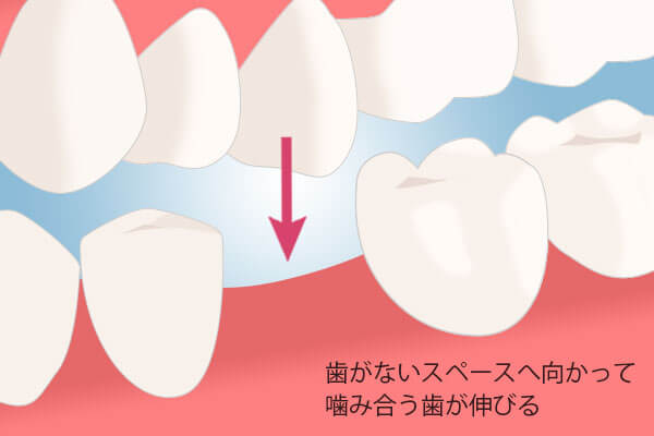 歯がないと歯のないところに反対側の歯が伸びてきます。