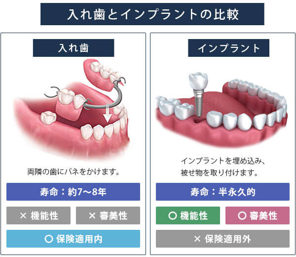 入れ歯 と インプラント