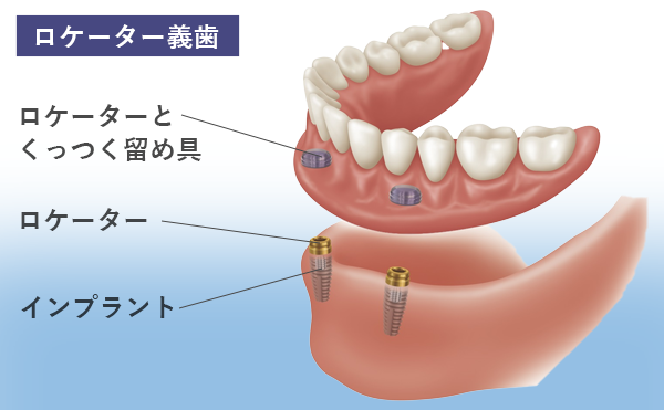 ロケーター義歯の構造