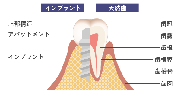 インプラントと天然歯の比較