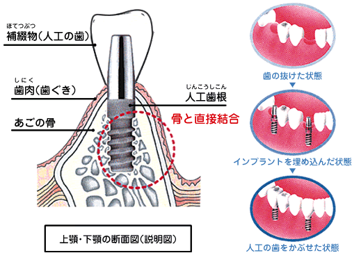 インプラントとは 大阪の専門医院