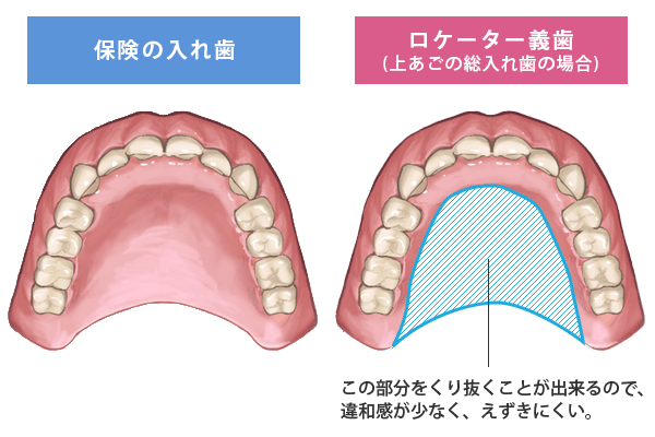 保険の入れ歯とロケーター義歯の比較