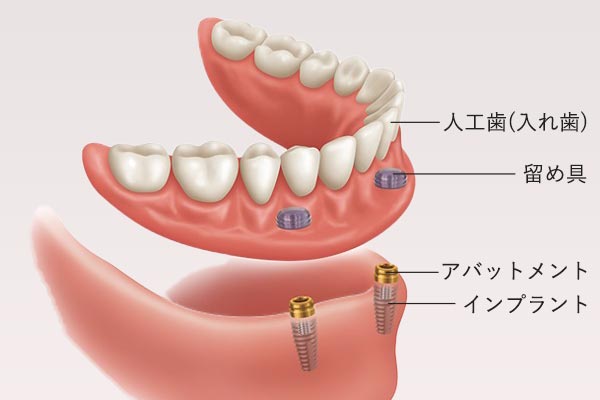 総入れ歯をしっかり固定！インプラントオーバーデンチャー｜大阪インプラント総合クリニック